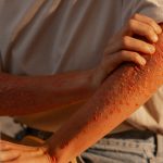 South Africa’s mpox cases rise as Health Department warns of rapid local transmission